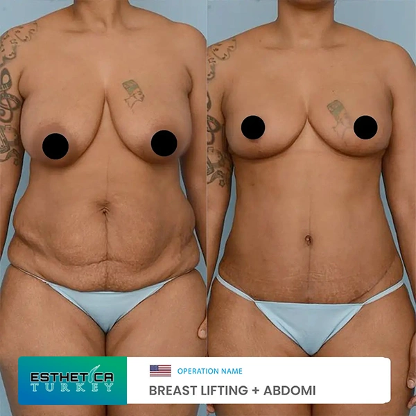 estetica clinic before after breat treatments (3)