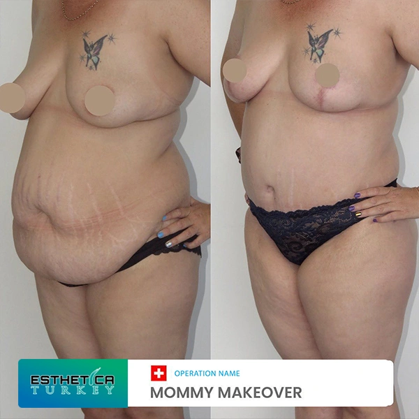 estetica clinic before after breat treatments (8)