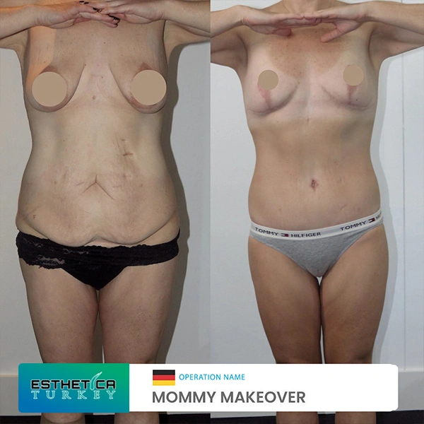 estetica clinic before after breat treatments (9)