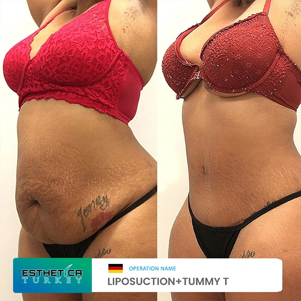 estetica plastic surgery before after (12)