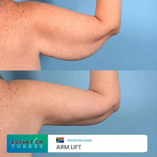 estetica plastic surgery before after (13)