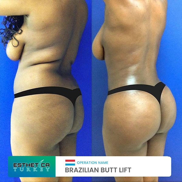 estetica plastic surgery before after (15)