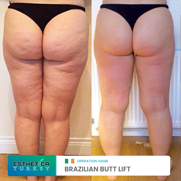 estetica plastic surgery before after (17)