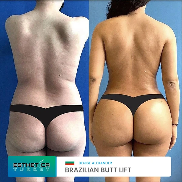 estetica plastic surgery before after (20)