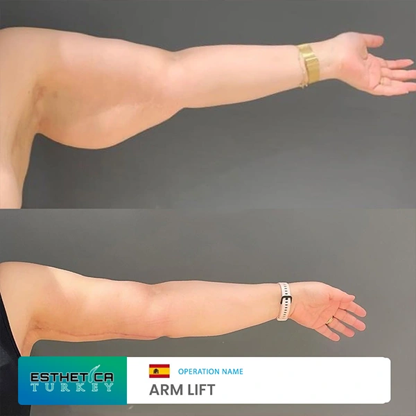 estetica plastic surgery before after (3)