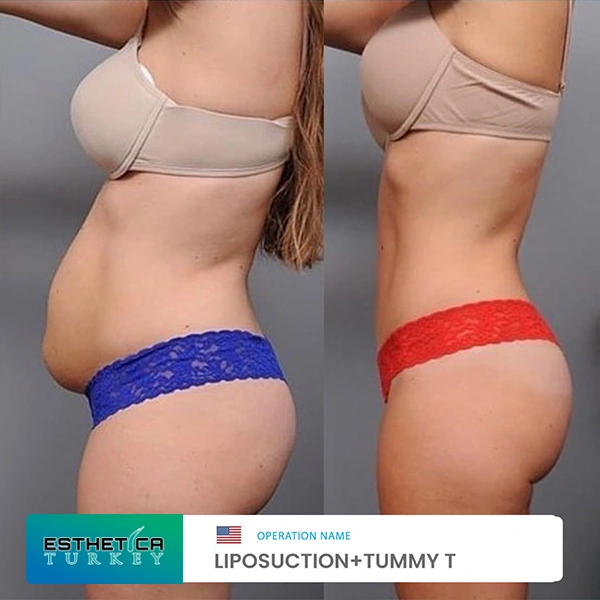 estetica plastic surgery before after (4)