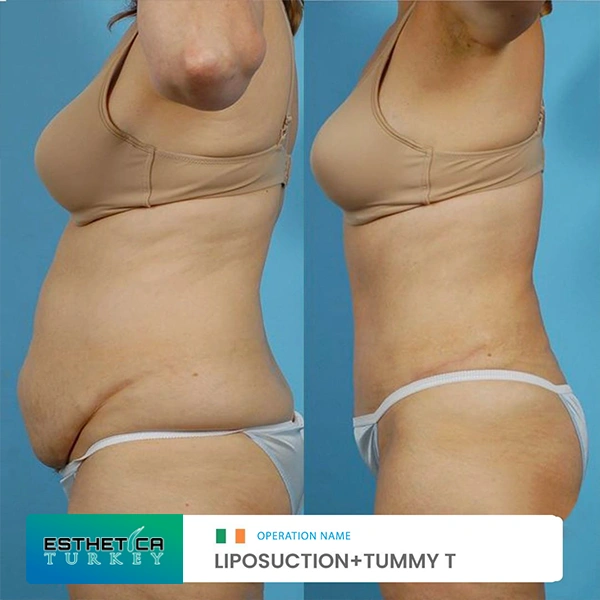 estetica plastic surgery before after (6)
